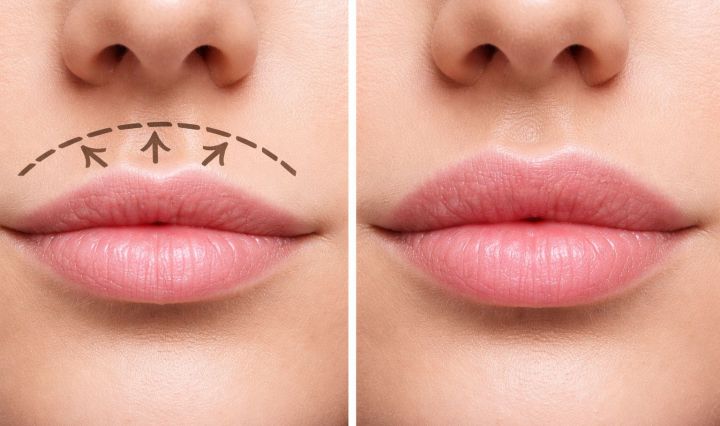 victor pochat lip lift